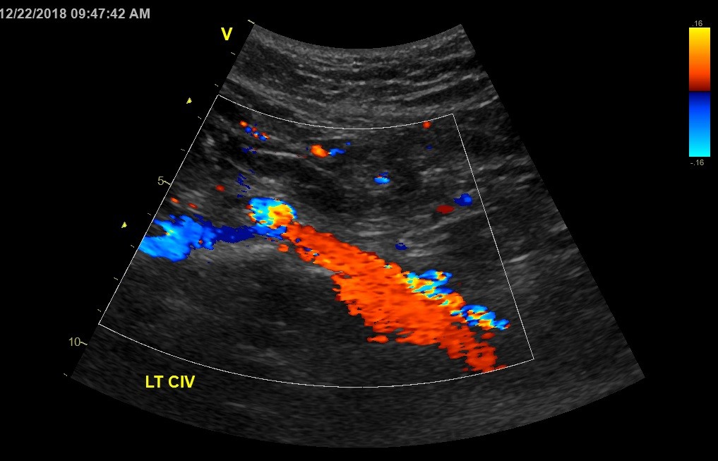 Turners Syndrome Ultrasound