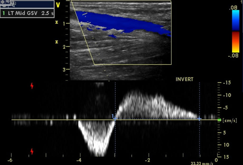 Gsv Course Radiology Varicose Veins, GSV, Endovenous Laser Ablation Study - Heart Vein NYC
